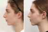 Rhinoplasty case #3992 slider thumbnail