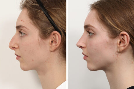 Rhinoplasty case #3992