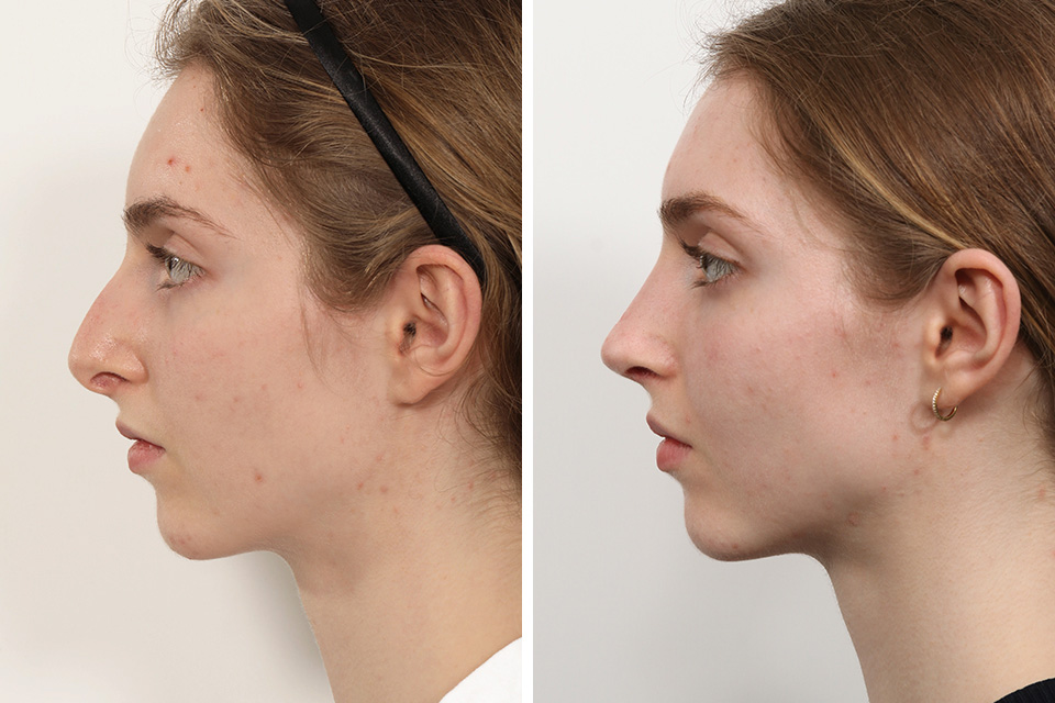 Rhinoplasty case #3992