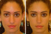 Rhinoplasty case #4276 slider thumbnail
