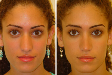 Rhinoplasty case #4276