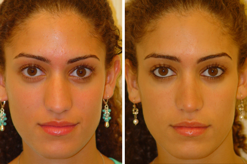 Rhinoplasty case #4276