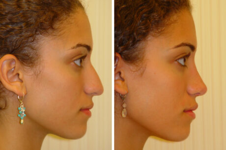 Rhinoplasty case #4276
