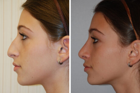 Rhinoplasty case #4288