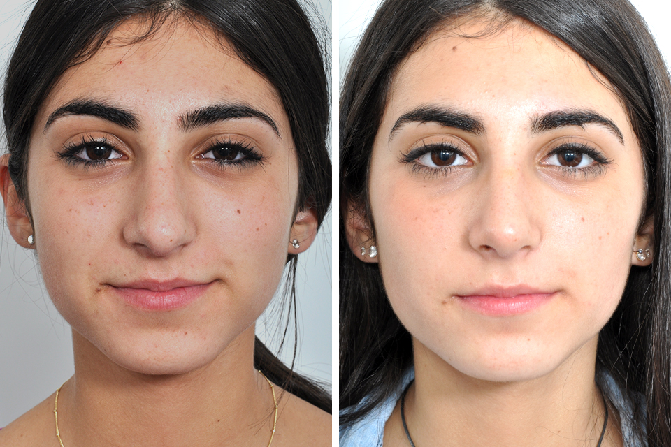Rhinoplasty case #4257