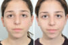 Rhinoplasty case #4271 slider thumbnail