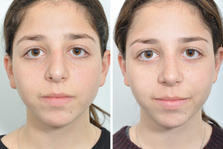 Rhinoplasty case #4271