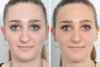 Rhinoplasty case #4228 slider thumbnail