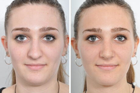 Rhinoplasty case #4228