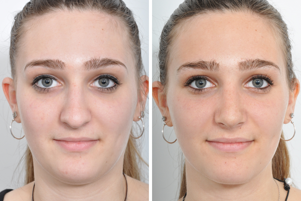 Rhinoplasty case #4228