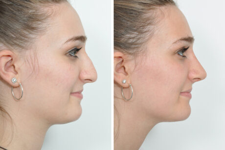 Rhinoplasty case #4228
