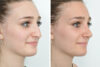 Rhinoplasty case #4228 slider thumbnail
