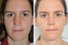 Rhinoplasty case #4279 slider thumbnail