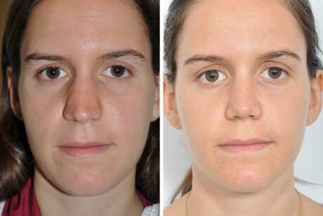 Rhinoplasty case #4279