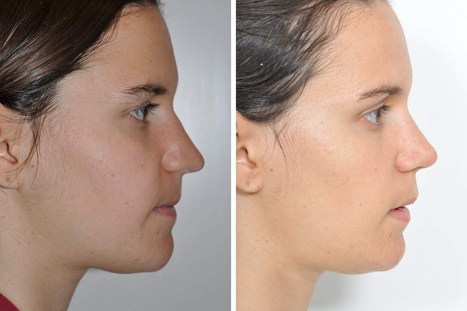 Rhinoplasty case #4279