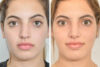 Rhinoplasty case #4151 slider thumbnail