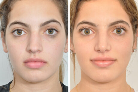 Rhinoplasty case #4151