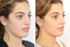Rhinoplasty case #4151 slider thumbnail
