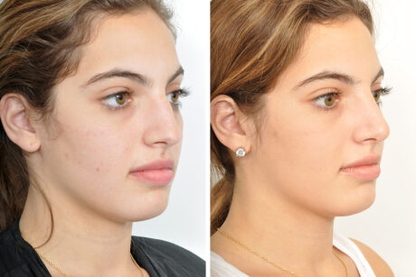 Rhinoplasty case #4151