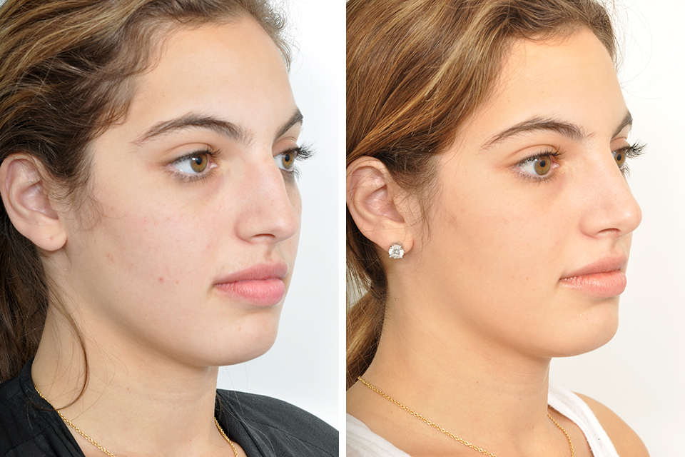 Rhinoplasty case #4151