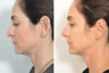 Rhinoplasty case #4264 slider thumbnail