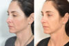 Rhinoplasty case #4264 slider thumbnail