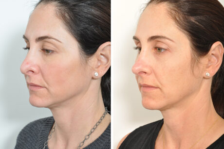 Rhinoplasty case #4264