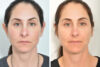 Rhinoplasty case #4264 slider thumbnail