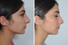 Rhinoplasty case #4257 slider thumbnail