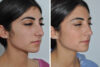 Rhinoplasty case #4257 slider thumbnail