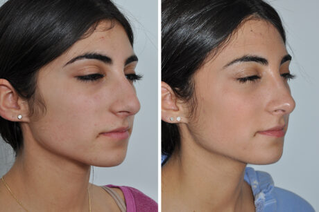 Rhinoplasty case #4257