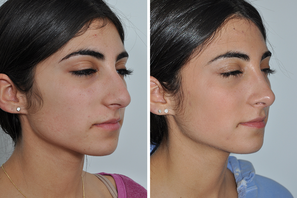 Rhinoplasty case #4257