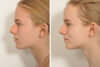 Rhinoplasty case #4261 slider thumbnail