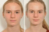 Rhinoplasty case #4261 slider thumbnail