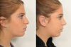 Rhinoplasty case #4088 slider thumbnail