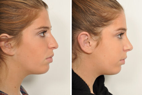 Rhinoplasty case #4088