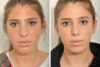 Rhinoplasty case #4088 slider thumbnail