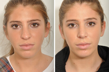 Rhinoplasty case #4088