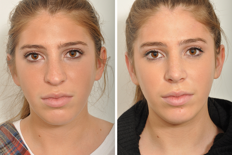 Rhinoplasty case #4088