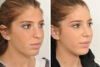 Rhinoplasty case #4088 slider thumbnail