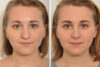 Rhinoplasty case #4243 slider thumbnail