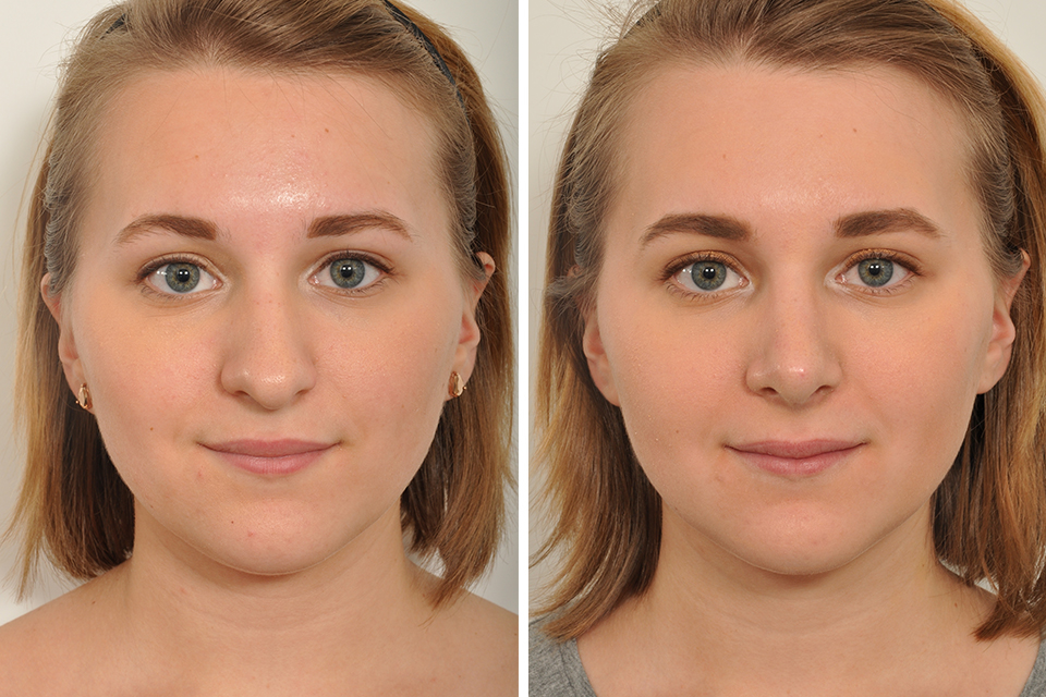 Rhinoplasty case #4243