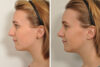 Rhinoplasty case #4243 slider thumbnail
