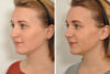 Rhinoplasty case #4243 slider thumbnail