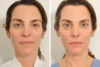 Rhinoplasty case #4217 slider thumbnail