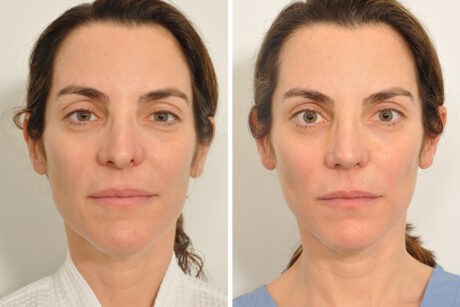 Rhinoplasty case #4217