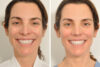 Rhinoplasty case #4217 slider thumbnail