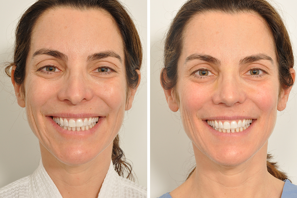 Rhinoplasty case #4217