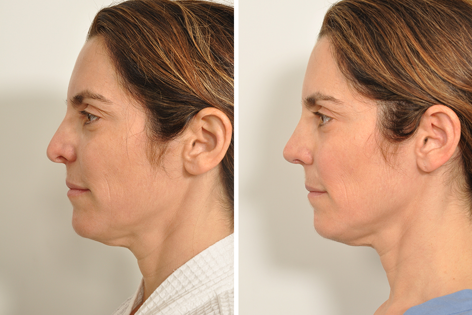 Rhinoplasty case #4217