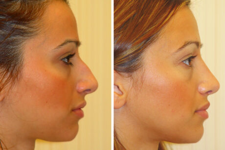 Rhinoplasty case #4290